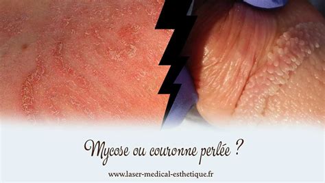 papule perlée|Couronne perlée ou papules nacrées, ensemble de boutons。